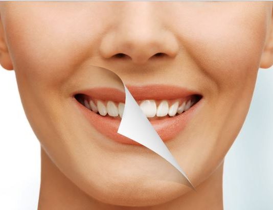 Restaurações Estéticas Restaurações estéticas