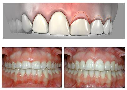 Gengivoplastia Tratamento de gengiva
