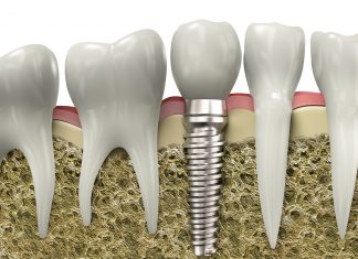 Implante dentário Implantes dentários