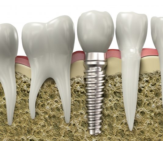Implante dentário Implantes dentários