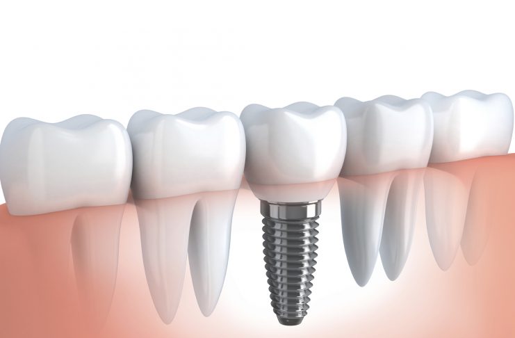 5 dúvidas sobre implantes Sorriso saudável