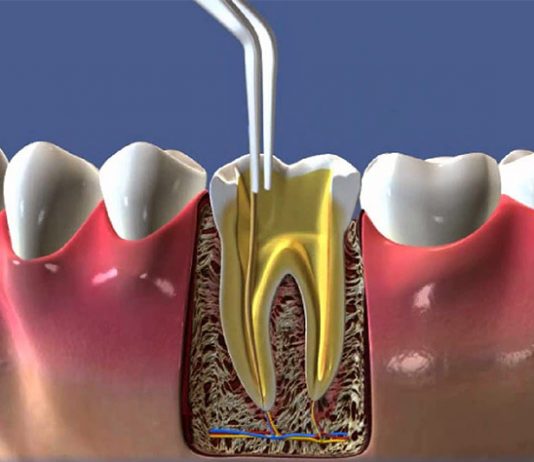 Tratamento de canal Donato e Mayhuire - Clínica Odontológica