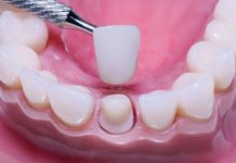 Coroas de porcelana Coroas de porcelana