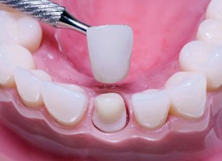 Coroas de porcelana Coroas de porcelana